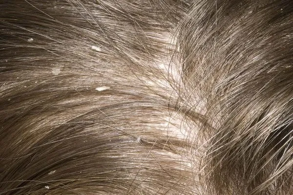 Dandruff