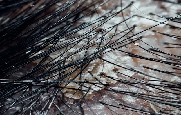 For Dry Scalp